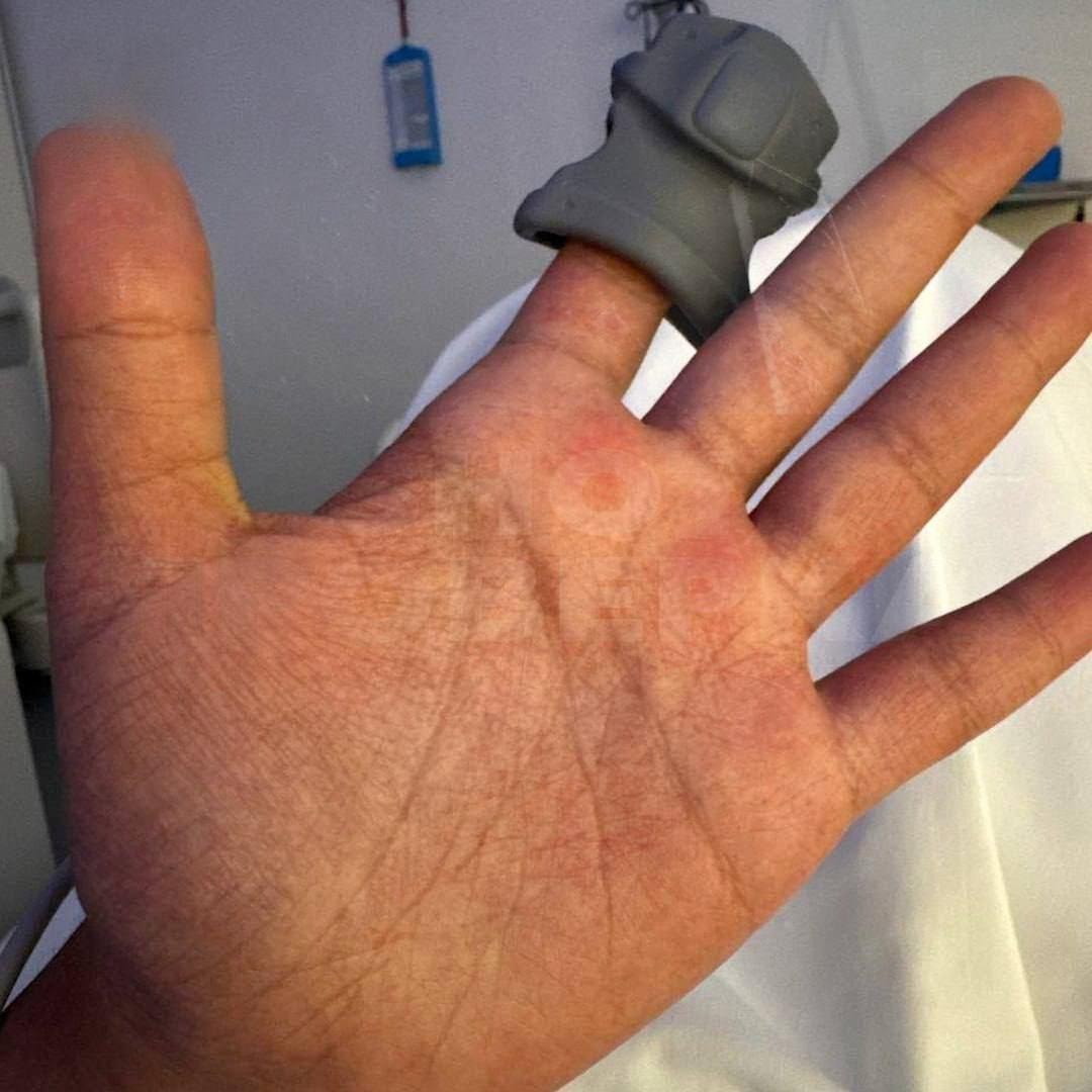 Роспотребнадзор контролирует сообщения о случаях лихорадки денге у российских туристов на Мальдивах