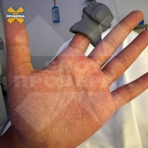 Случаи заболевания смертельно опасной лихорадкой денге фиксируют у российских туристов на Мальдивах