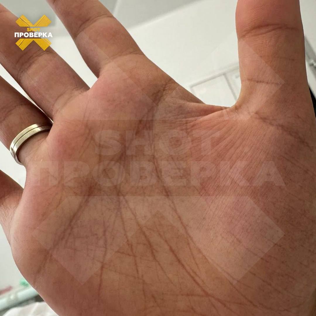 Случаи заболевания смертельно опасной лихорадкой денге фиксируют у российских туристов на Мальдивах Случаи заболевания смертельно опасной лихорадкой денге фиксируют у российских туристов на Мальдивах