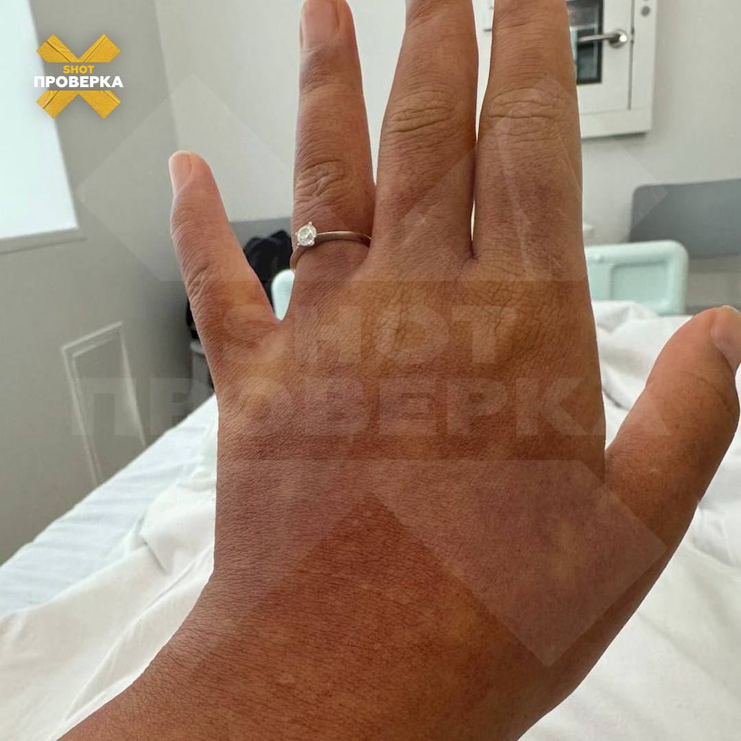 Случаи заболевания смертельно опасной лихорадкой денге фиксируют у российских туристов на Мальдивах Случаи заболевания смертельно опасной лихорадкой денге фиксируют у российских туристов на Мальдивах