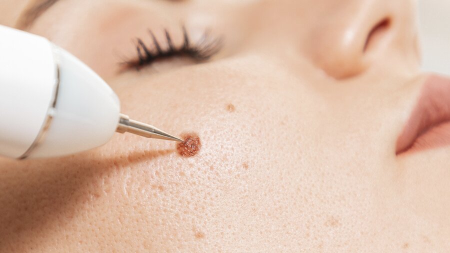 Тревога среди врачей нарастает стремительно: на маркетплейсах начали продавать «лазерные ручки» для удаления родинок и других нежелательных образований