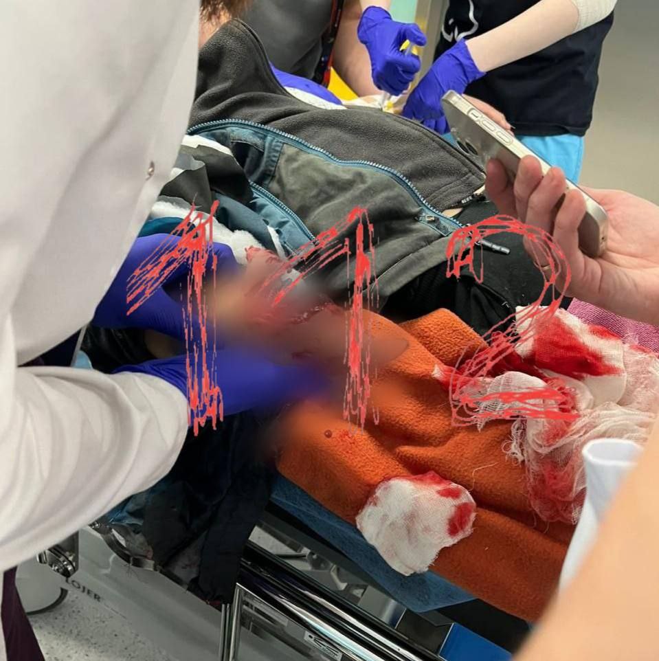 Новости к этому часу:. В Красногорске 10-летнему мальчику оторвало пальцы на руке, когда он поднял с земли на спортивной площадке 10-рублевую купюру — она оказалась привязана к коробочке с СВУ, начиненным гвоздями Новости к этому часу:. В Красногорске 10-летнему мальчику оторвало пальцы на руке, когда он поднял с земли на спортивной площадке 10-рублевую купюру — она оказалась привязана к коробочке с СВУ, начиненным гвоздями