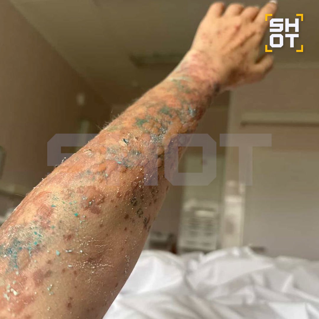 Москвичка попала в реанимацию и едва не умерла после принятия таблеток от биполярного расстройства Москвичка попала в реанимацию и едва не умерла после принятия таблеток от биполярного расстройства