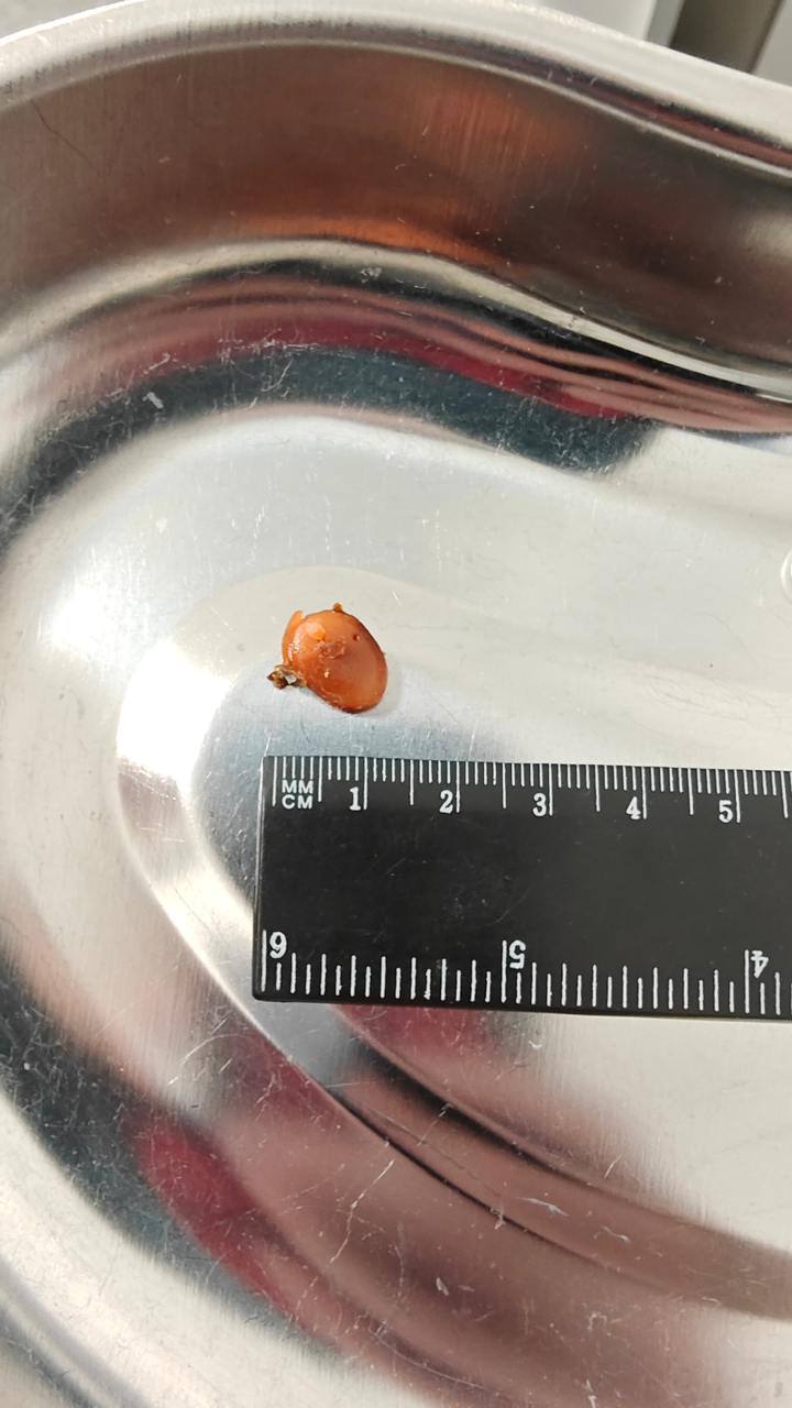 Парень из Подмосковья оглох на одно ухо из-за коллег