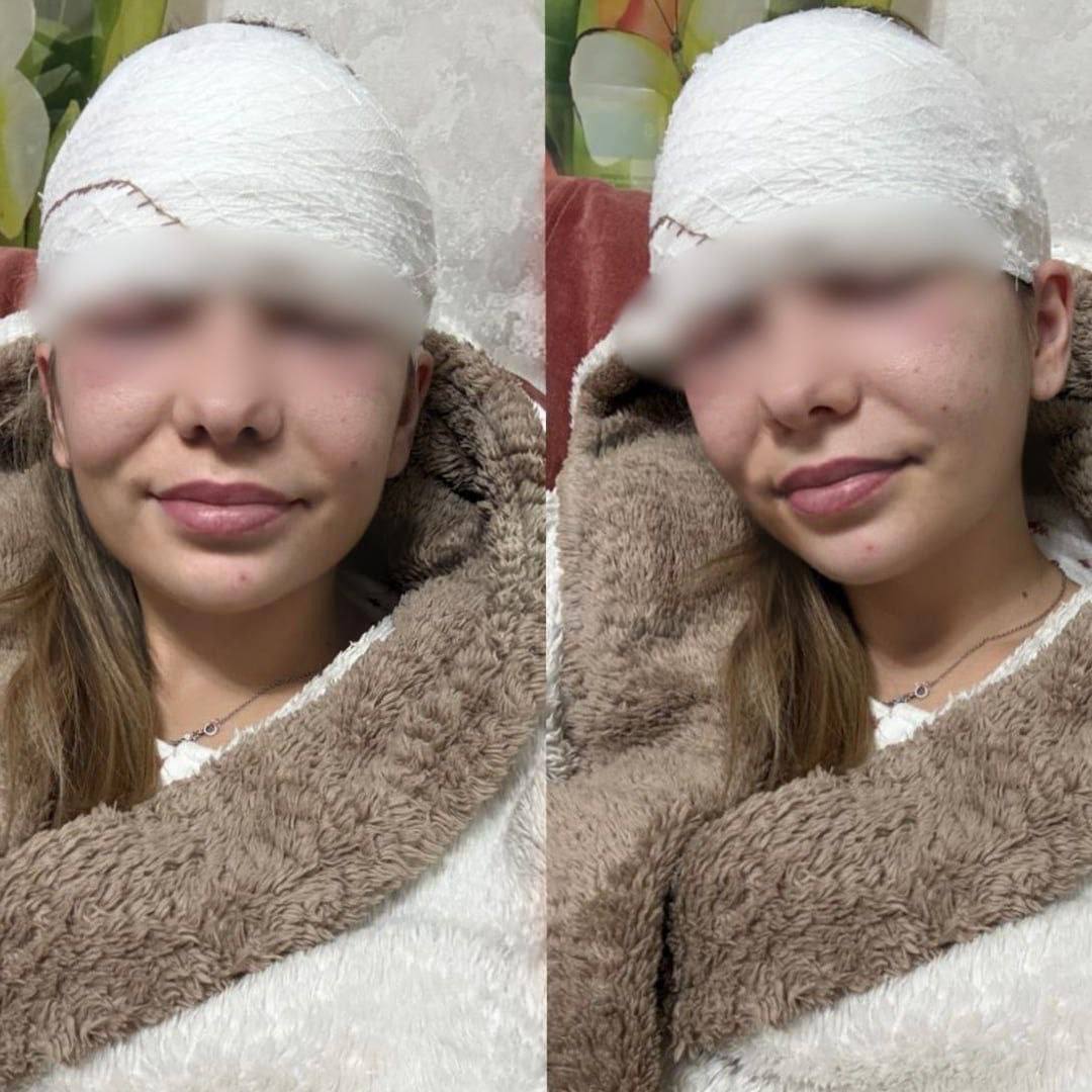 Россиянке разрезали лоб из-за выдавленного прыща