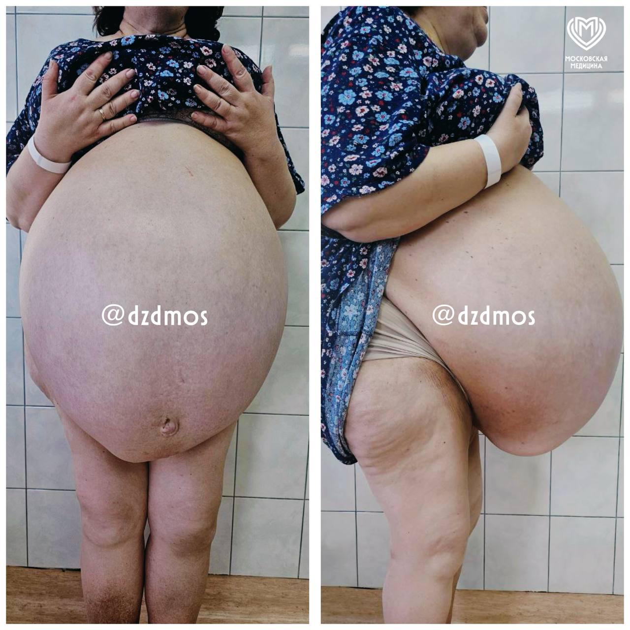 В Москве женщине удалили кисту печени размером с два баскетбольных мяча: