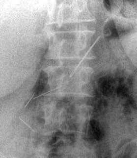 Женщина месяц жила с иглами в животе