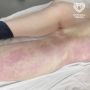 Москвичку спасли после укуса гадюки