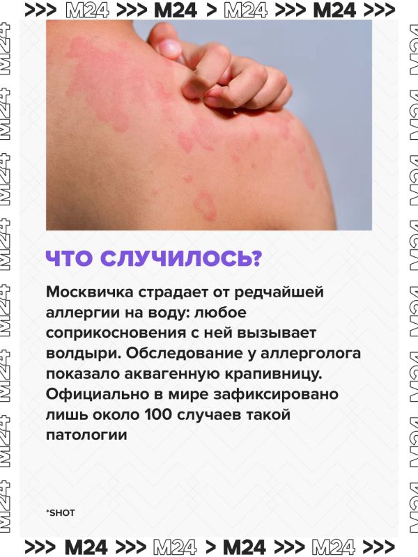 У москвички проявилась крайне редкая форма аллергии: кожа покрывается волдырями при любом контакте с водой У москвички проявилась крайне редкая форма аллергии: кожа покрывается волдырями при любом контакте с водой