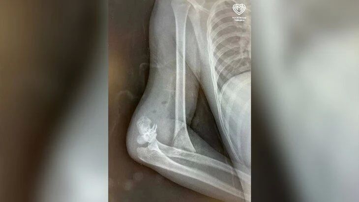 В Москве спасли 9-летнего мальчика, упавшего с питбайка